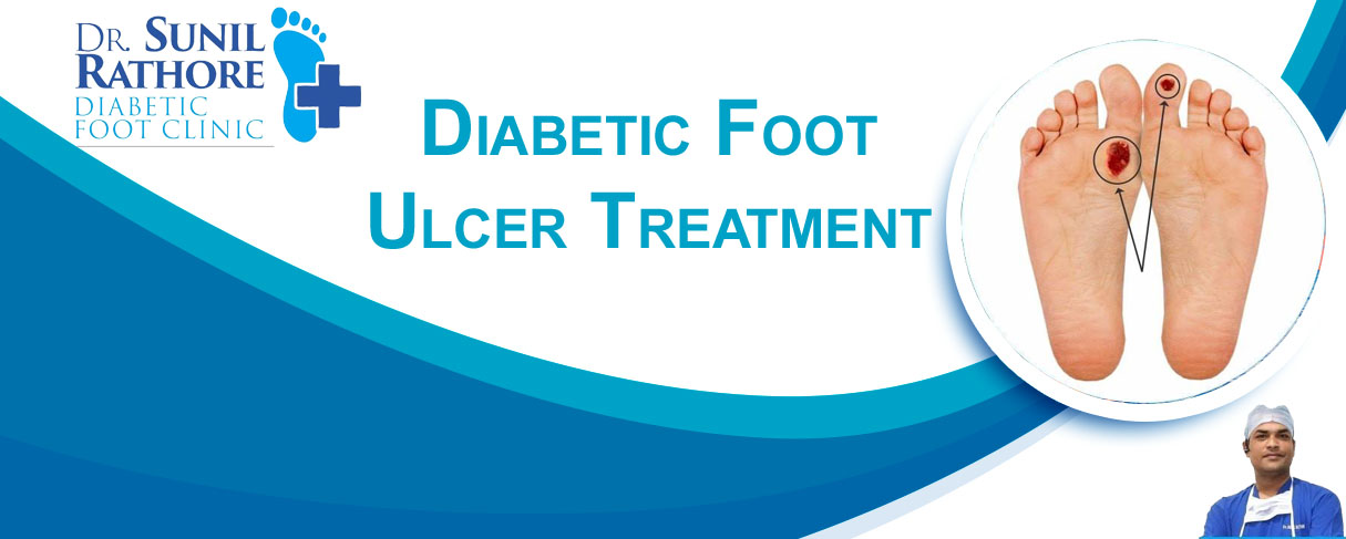 diabetic-foot-ulcer-treatment