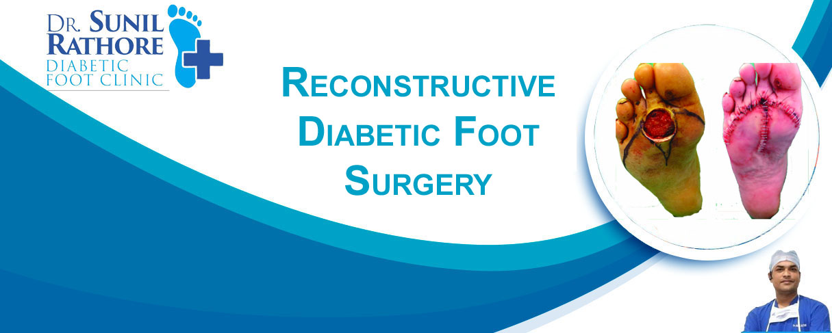 diabetic-foot-ulcer-treatment